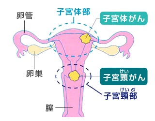 子宮がんとは